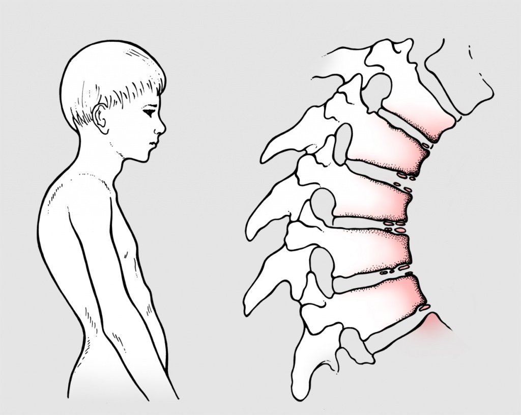 Осанка за компьютером картинки
