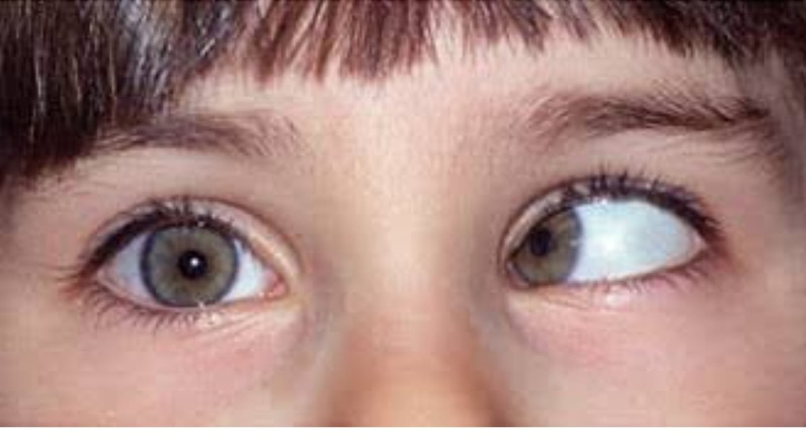 Ребенок косит глазки. Обскурационная амблиопия. Косоглазие у детей. Дети с косыми глазами. Сильное косоглазие.